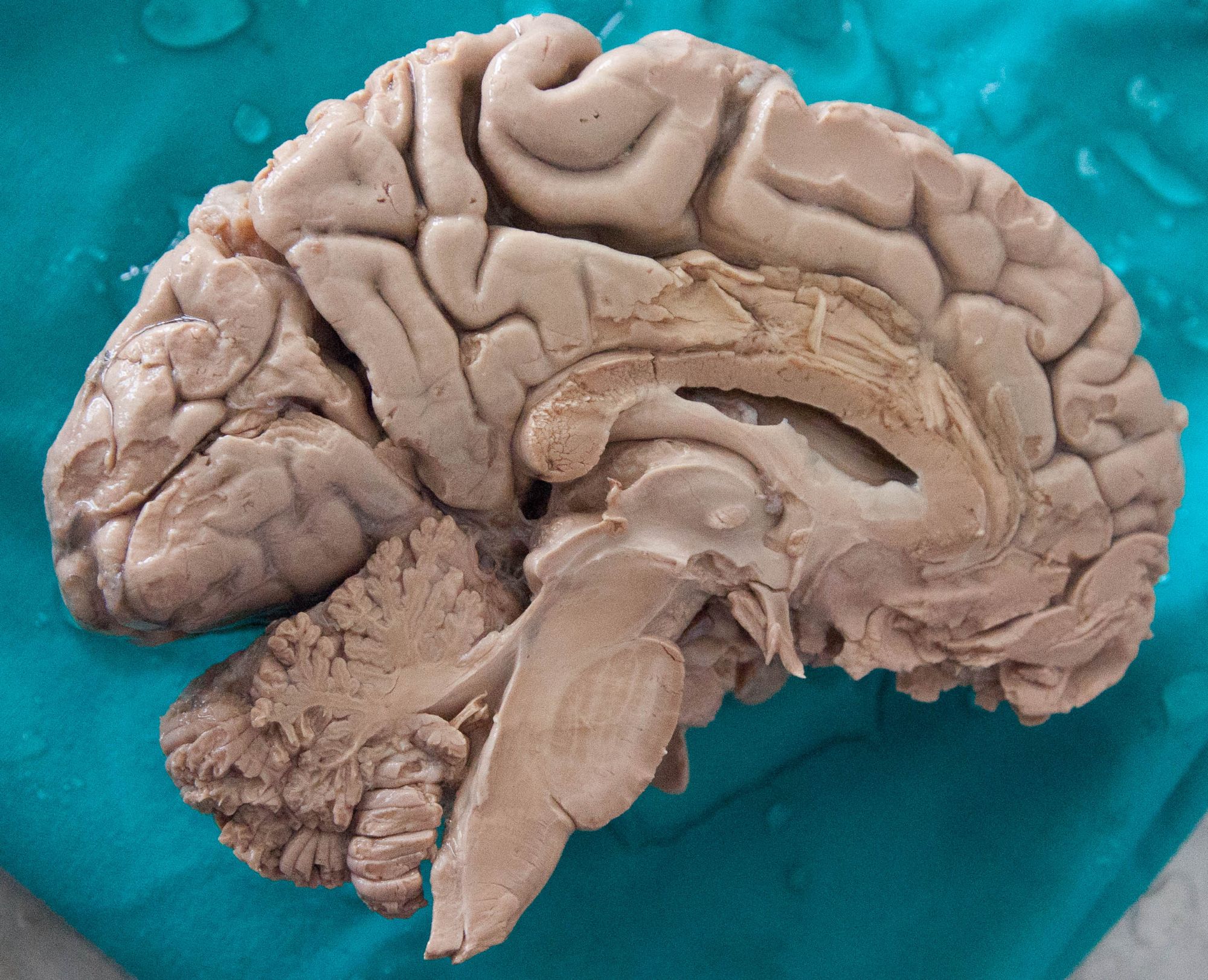 A human brain dissected.